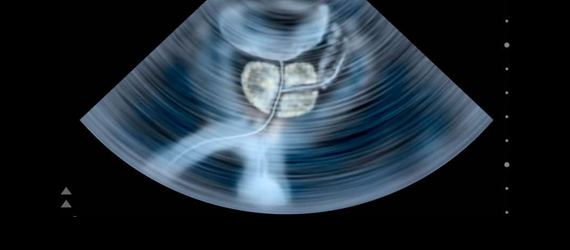 Ecografía Prostática